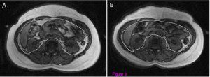 Varady UIC Study MRI Images Visceral-Fat